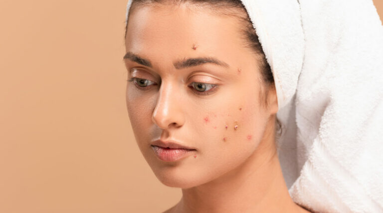 Acne Care Brand: Your Comprehensive Guide to Clearer, Healthier Skin